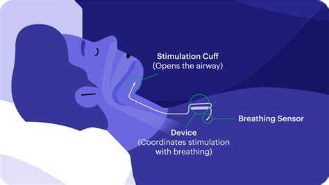 This treatment is especially a great option for people with severe obstructive sleep apnea who cannot use or do not respond well to continuous positive airway pressure therapy. . Inspire sleep apnea reviews 2022